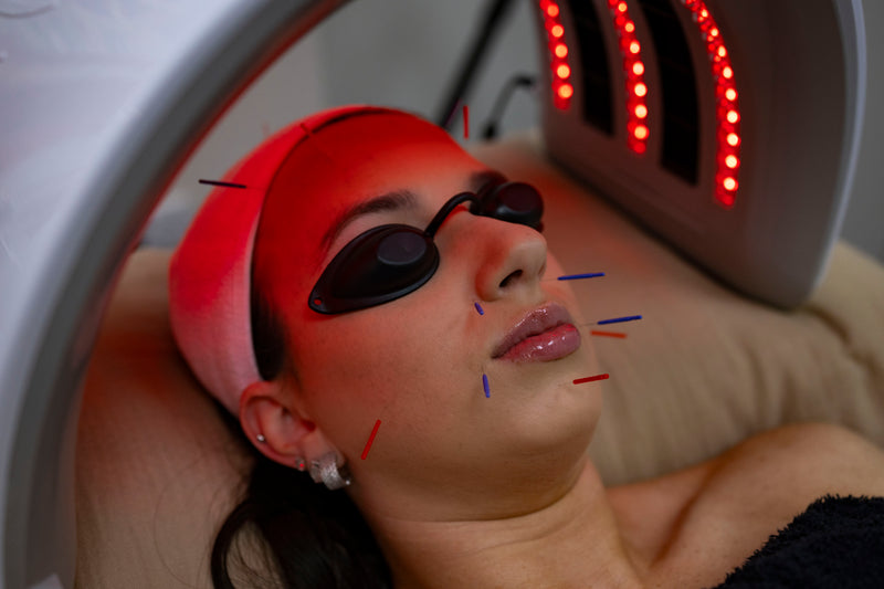 Cosmetic Acupuncture