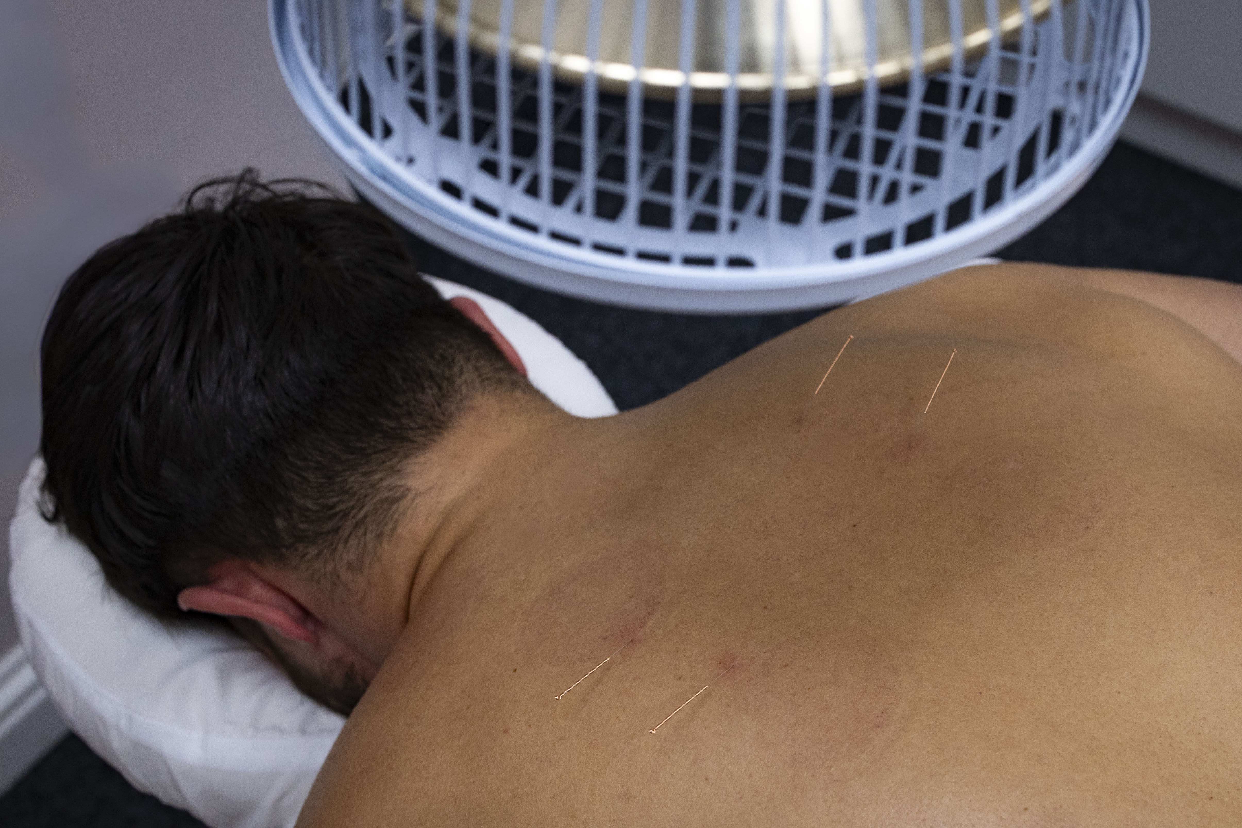 Acupuncture – Jo Mac Acupuncture