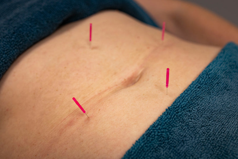 Acupuncture for Fertility