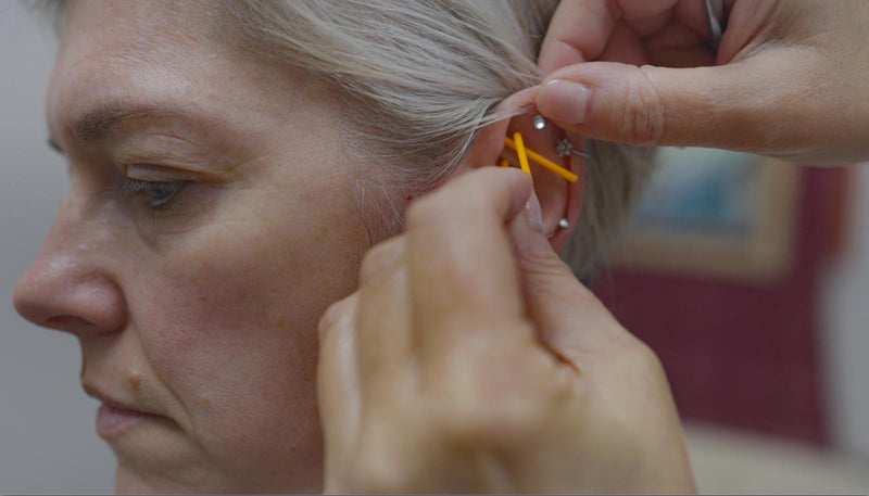 Ear Acupuncture