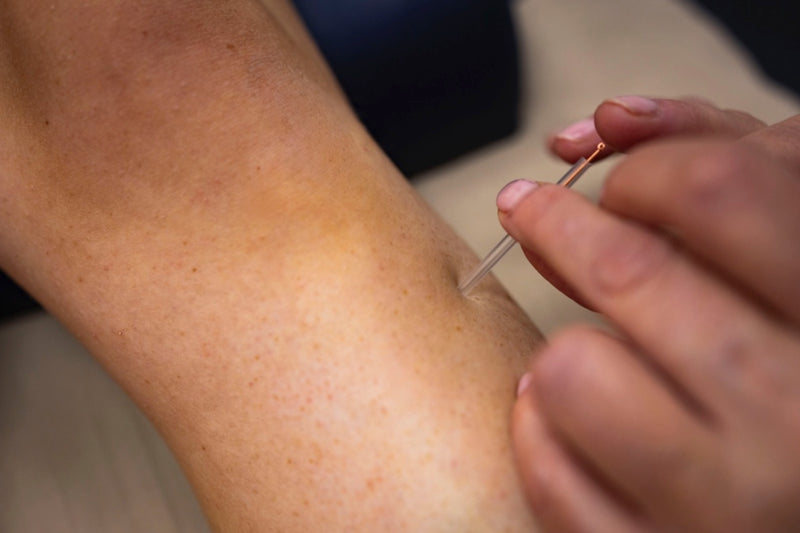 Acupuncture for Hormonal Health